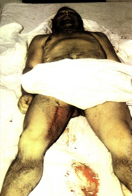 Joseba Arregi 1981 zum Tod gefoltert